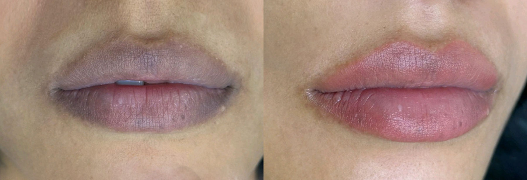 antes y después labios